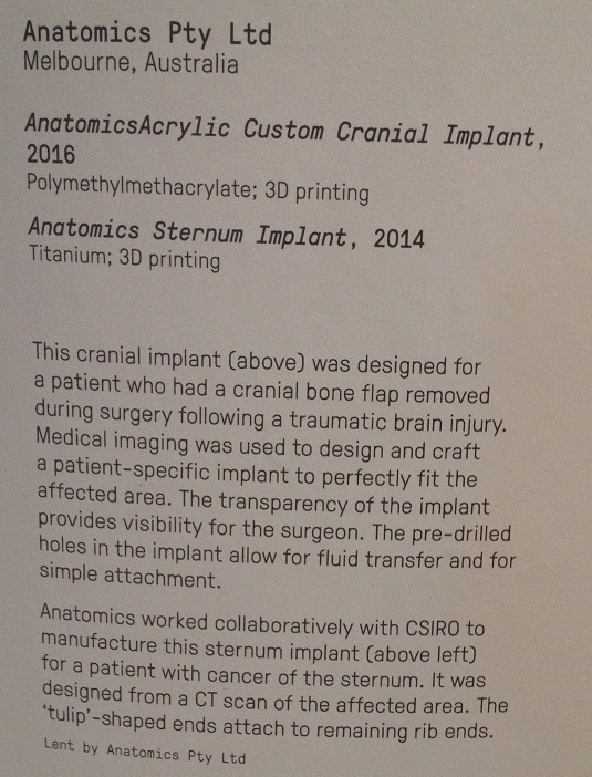 3d-printed-sternum-implant-2